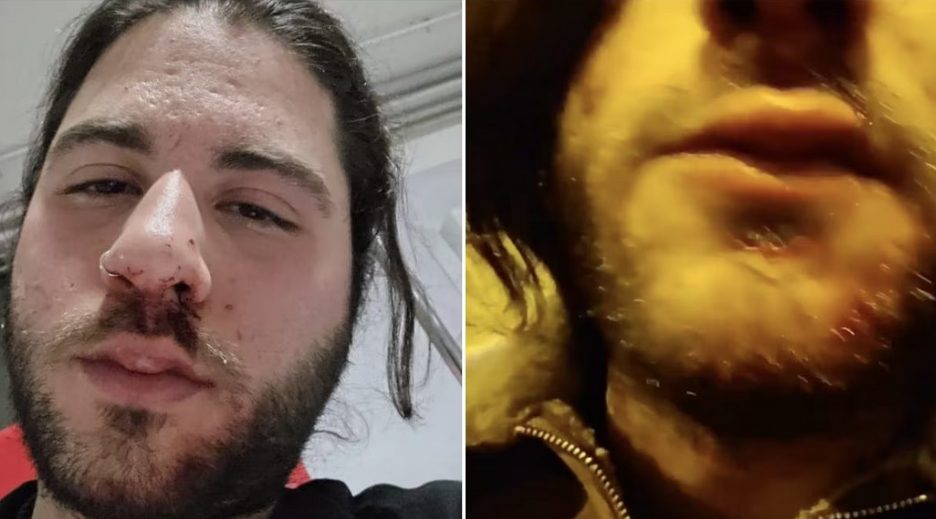 artista strada picchiato titolare bar denuncia