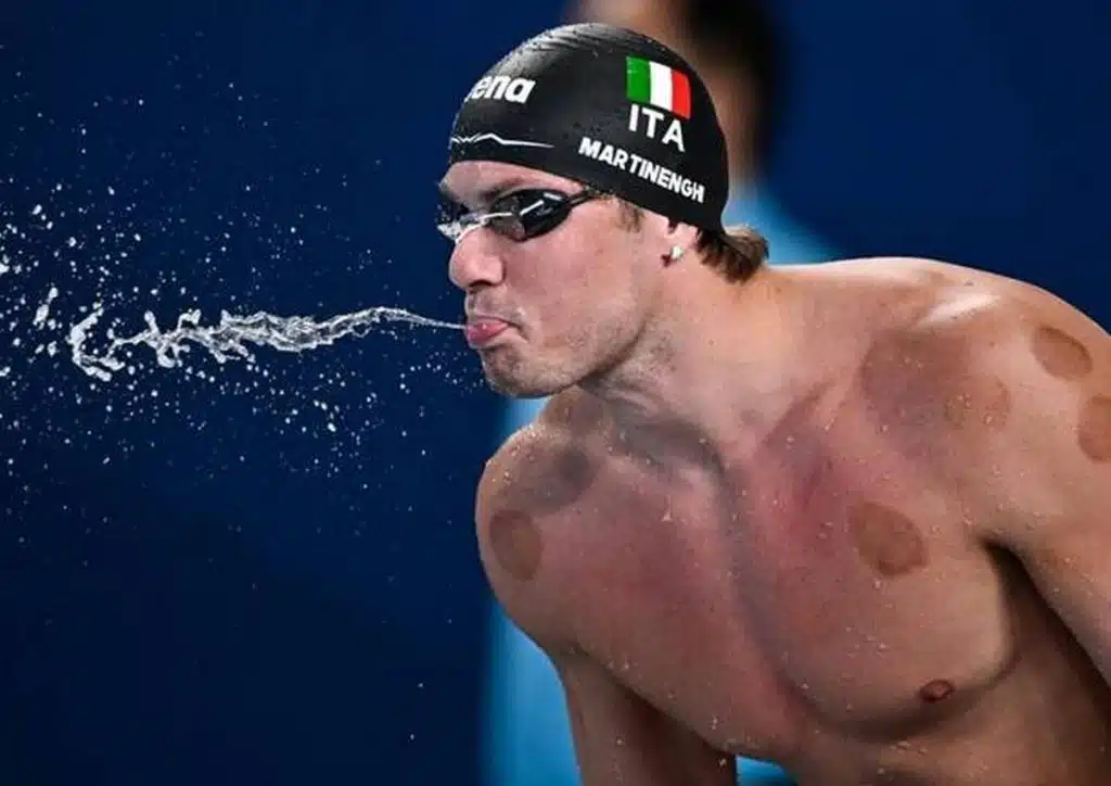 cosa sono cerchi scuri martinenghi olimpiadi 2024 benefici pratica coppettazione