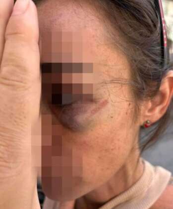 Napoli donna aggredita pugno faccia