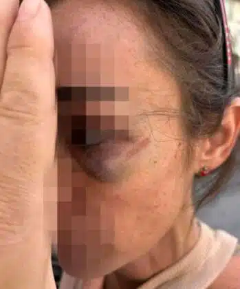 Napoli donna aggredita pugno faccia