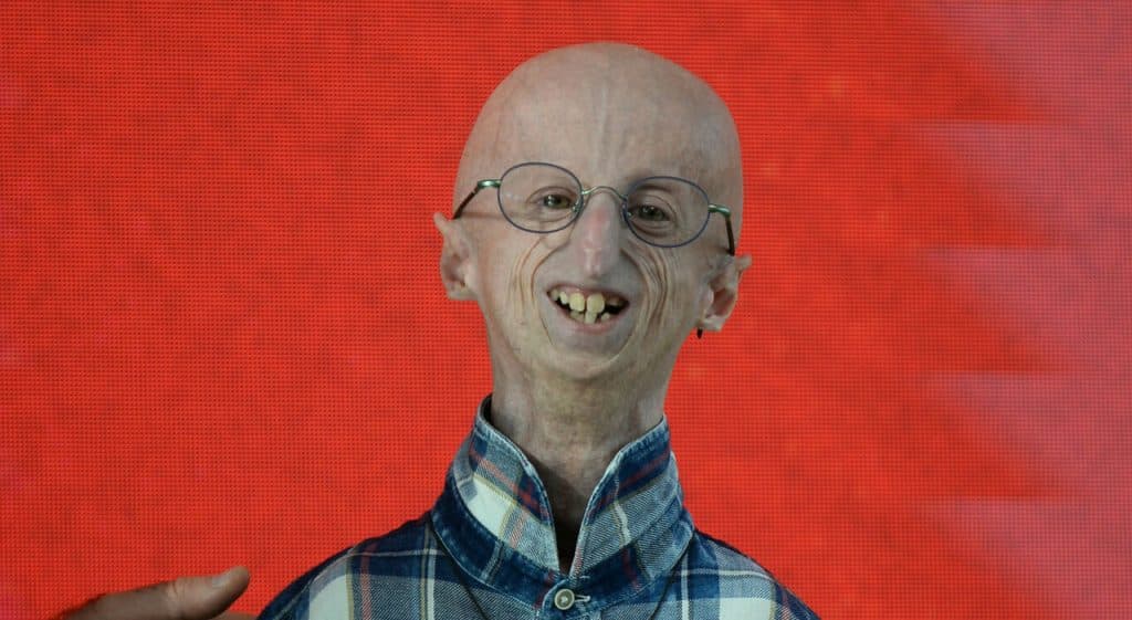 morto Sammy Basso simbolo lotta contro progeria