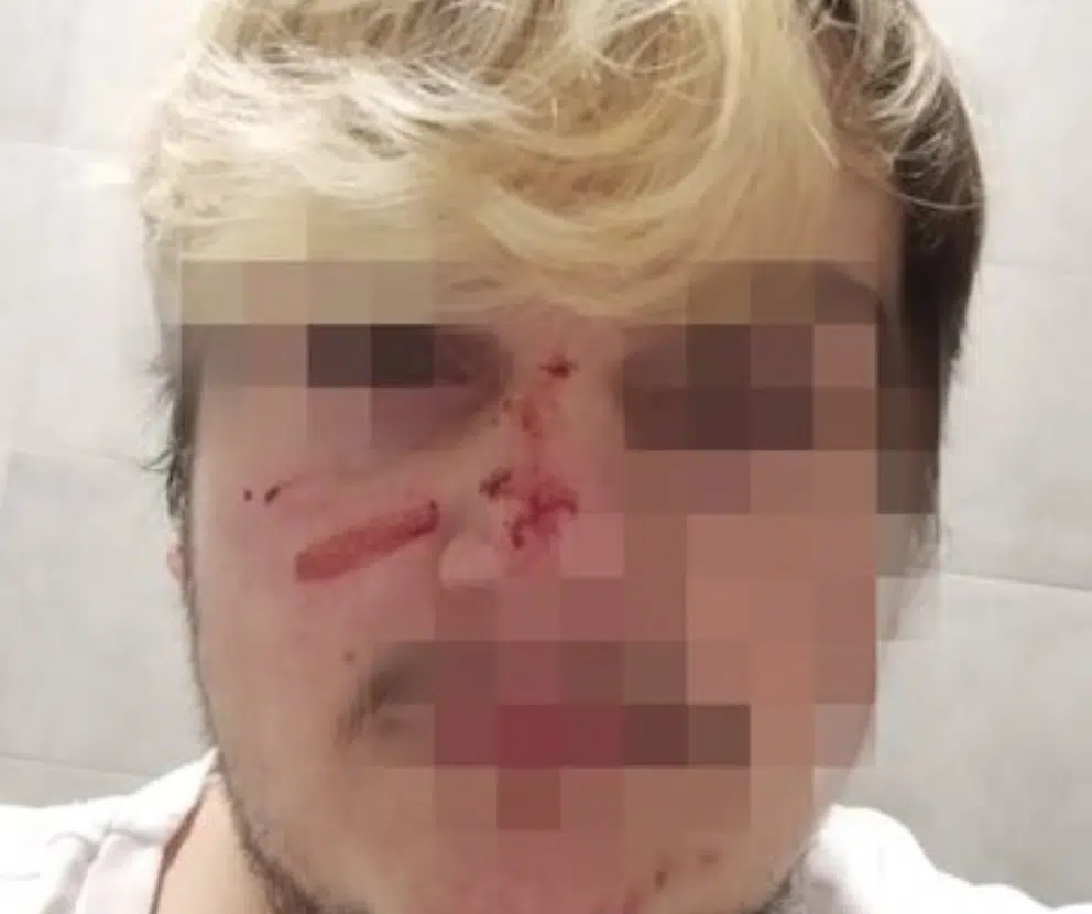 Bacoli ragazzo picchiato suonato clacson 