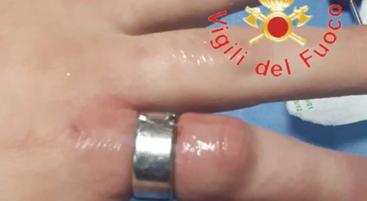 anello incastrato salerno intervento delicato 24 febbraio