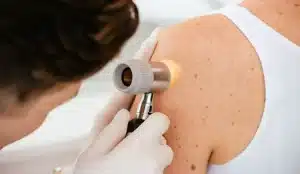 salerno melanoma visite gratuite spiaggia santa teresa