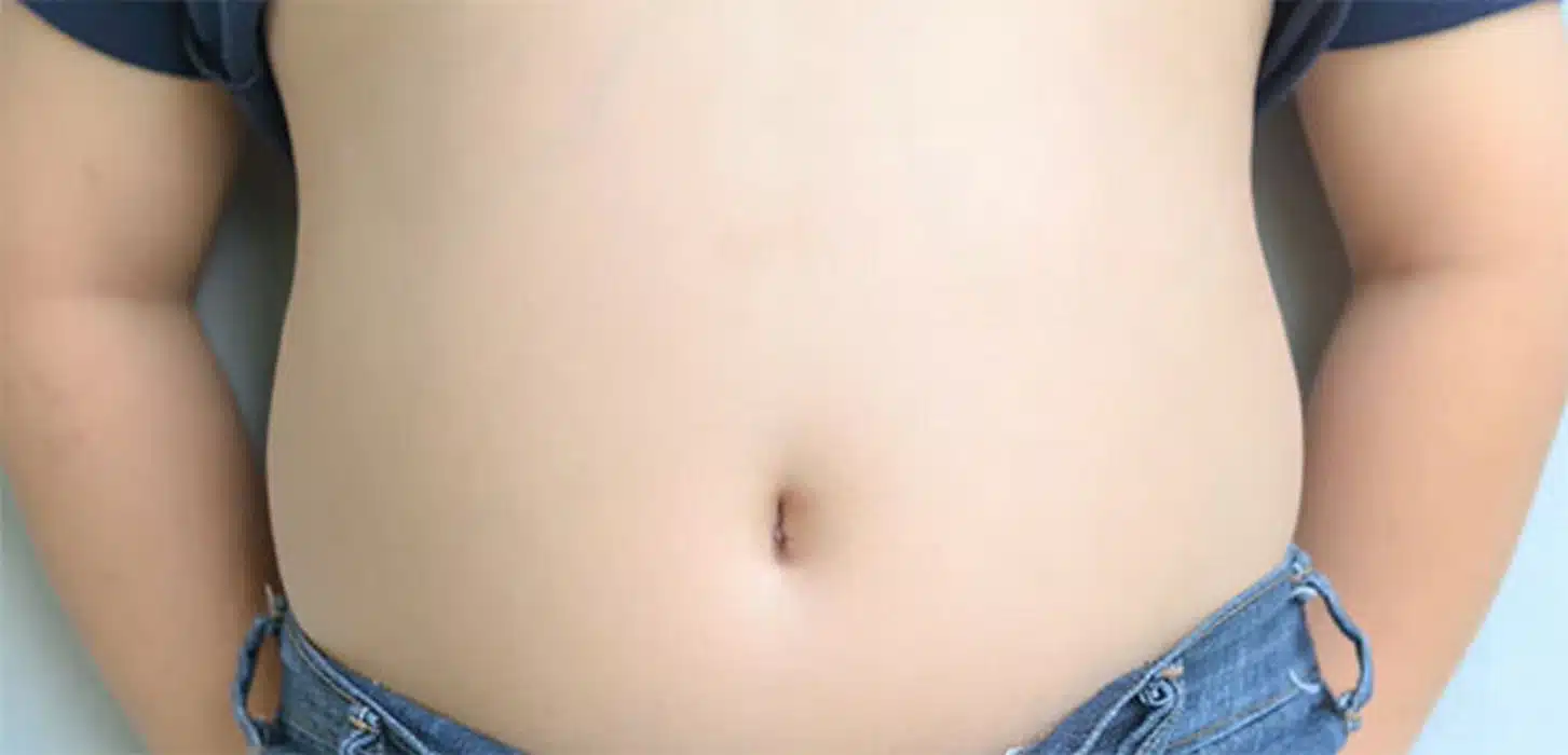 obesità infantile campania primo studio