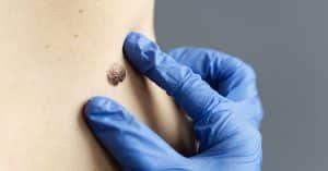 campania nasce dipartimento oncologico interaziendale cute