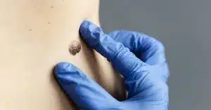 campania nasce dipartimento oncologico interaziendale cute