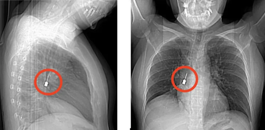 reggio calabria cacciavite rimosso bronchi donna